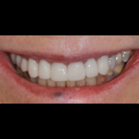 Dental restoration replaced with new beautiful restoration