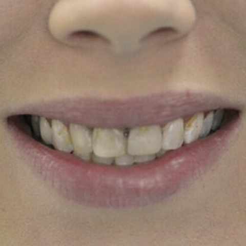Decayed and discolored top teeth