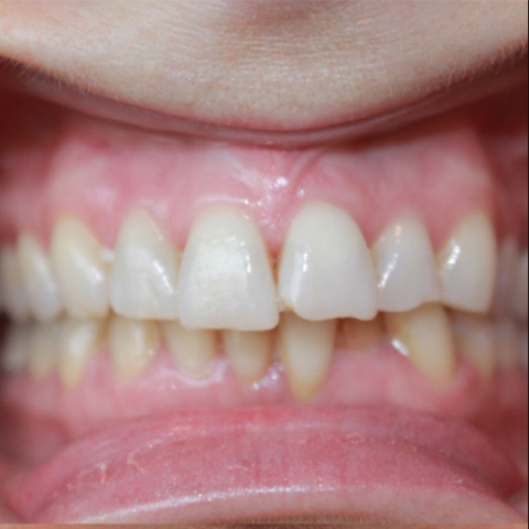 Damaged front tooth before dental treatment