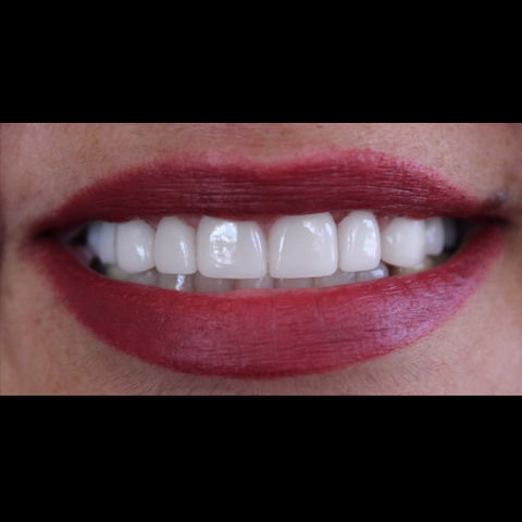 Gap between front teeth closed with dental treatment