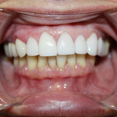 Brigtened smile after professional teeth whitening