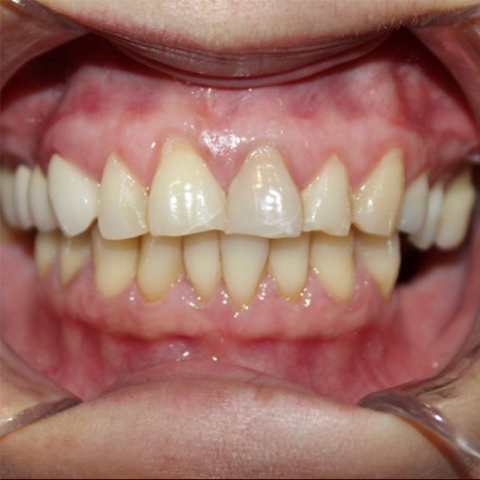 Yellowed smile before professional teeth whitening