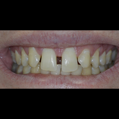Large gap between front two teeth