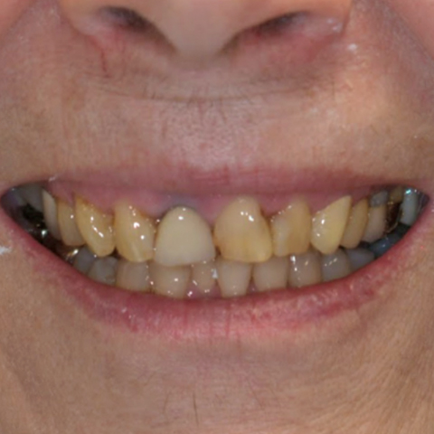 Decayed smile before dental treatment