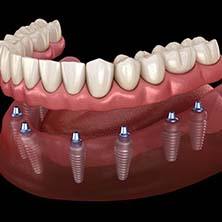 Illustration of implant dentures in Spring