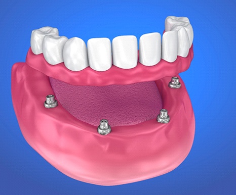 Animated implant-retained denture