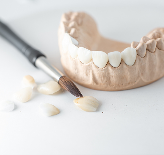 Several dental crowns next to a model of the teeth