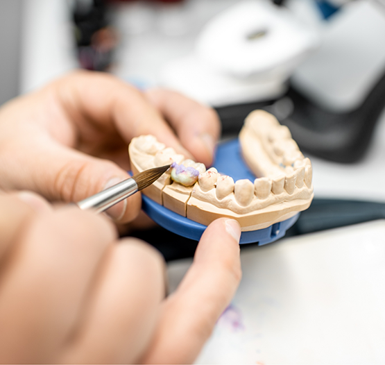 Dental professional adjusting a crown on a model of the teeth