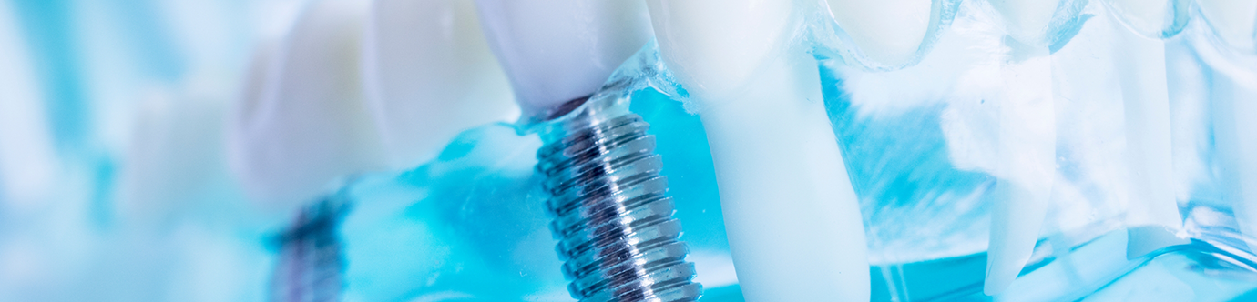 Model of the mouth with two dental implants in Spring replacing missing teeth