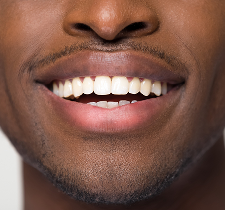Close up of a smile with flawlessly straight teeth