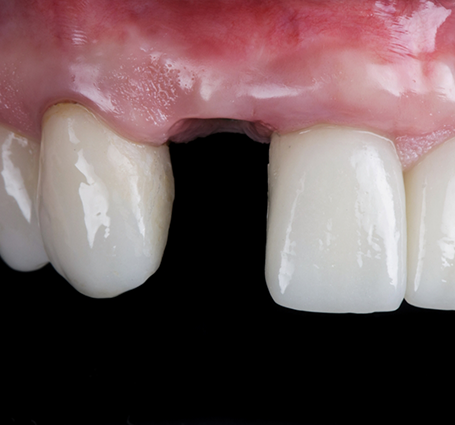 Close up of a mouth with one missing upper tooth