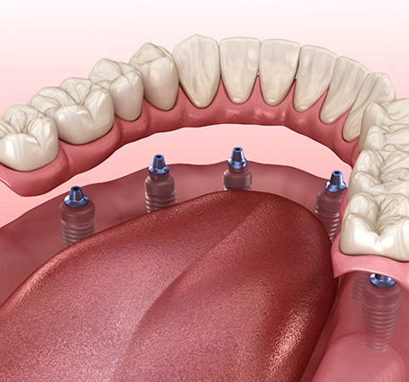 Illustration of an implant denture supported by six implants