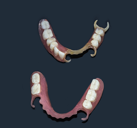 Two partial dentures