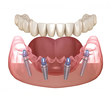 Illustration of a full denture being placed over four dental implants