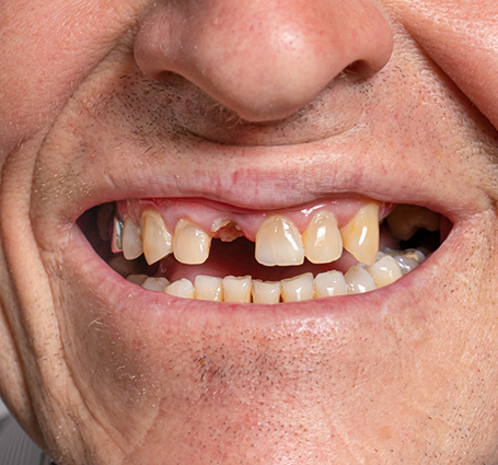Close up of a smile with several missing teeth