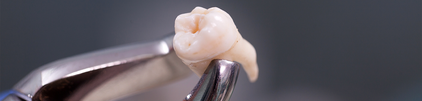 Forceps holding an extracted tooth