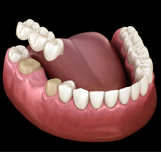 Illustration of a dental bridge replacing a missing tooth