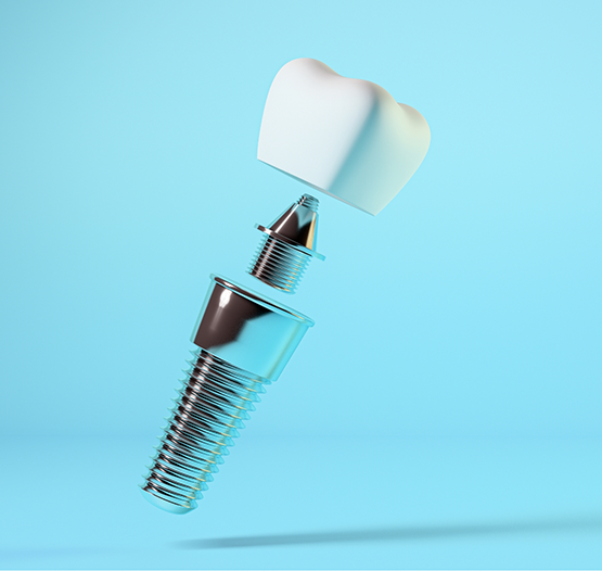 Model of a dental implant with a crown and abutment connector piece
