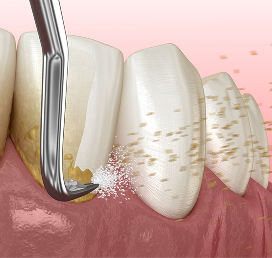 Illustration of a dental scaler clearing tartar from the gums and teeth