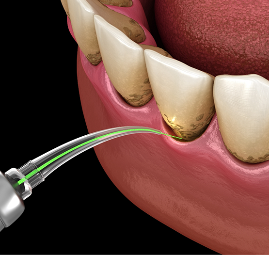 Illustration of a dental laser treating the gums