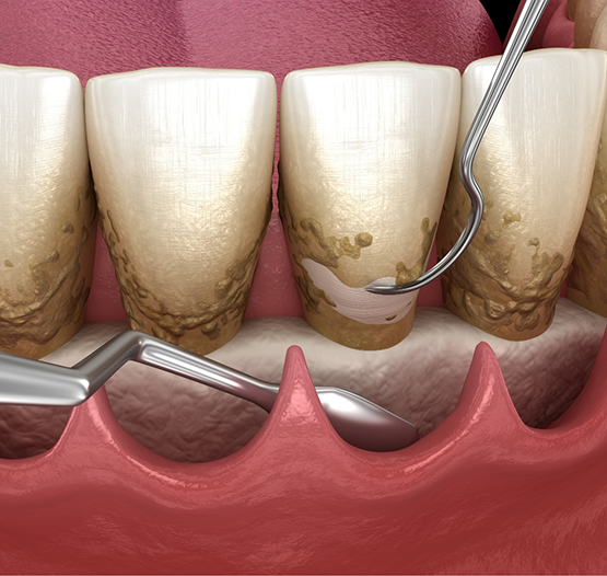 Illustration of dental instruments removing tartar from the gumline
