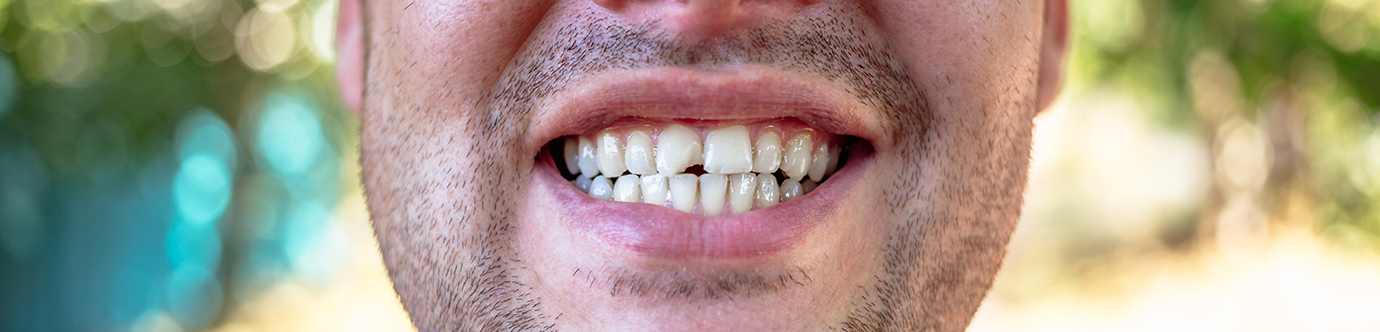 Man smiling with a chipped tooth before restorative dentistry treatment