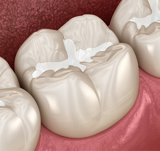 Illustrated teeth with white fillings