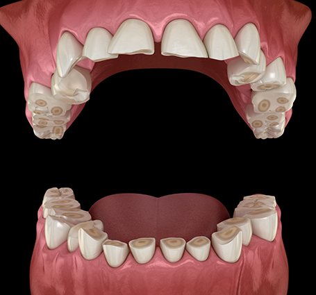 Illustration of worn down teeth from grinding