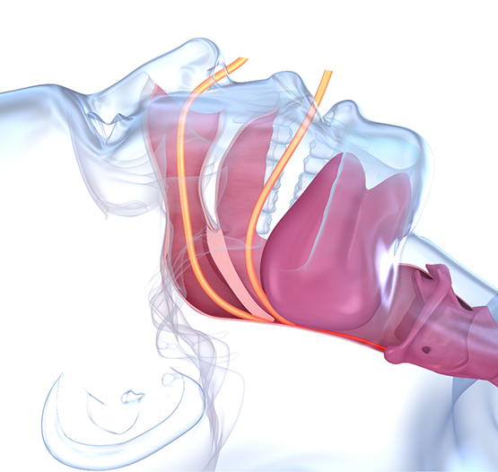 Illustration of the blocked airway of someone with sleep apnea