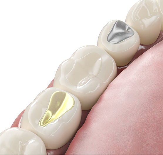 Illustration of teeth with tooth colored fillings between teeth with metal fillings