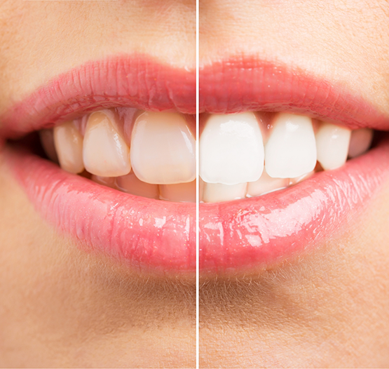 A smile before and after teeth whitening