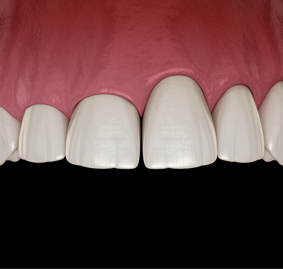 Illustration of a mouth with an uneven gumline on the upper arch