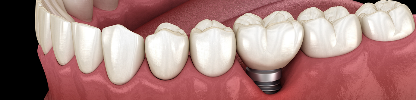 Illustration of a failed dental implant in receding gums