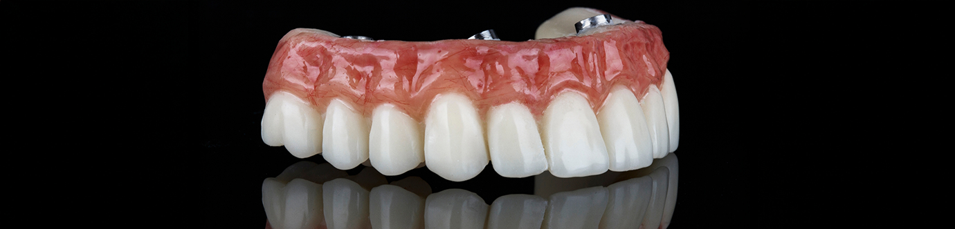 Model of an implant denture in Spring