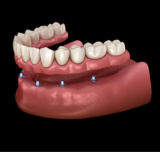 Illustration of six dental implants throughout the arch supporting a full denture