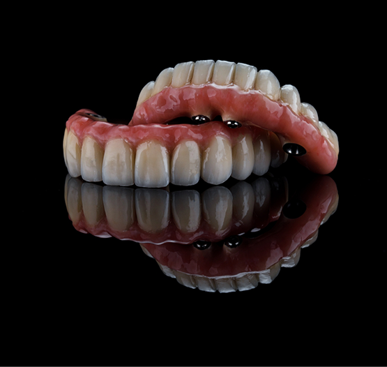 Set of full implant dentures