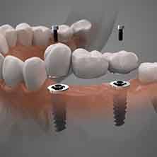 Digital illustration of an implant bridge