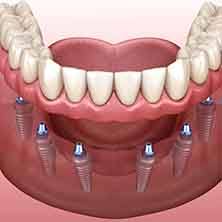 Digital illustration of an implant denture