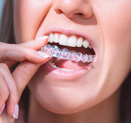 Close up of a woman placing an Invisalign tray over her teeth