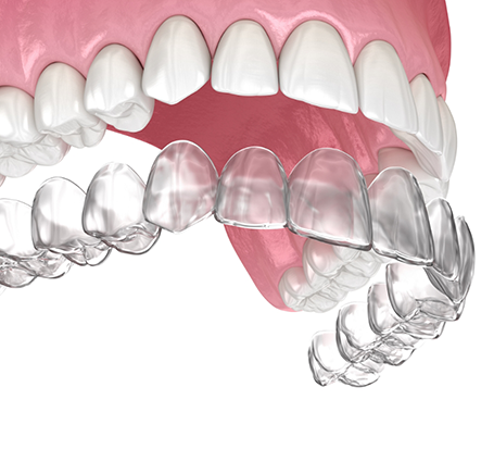 Illustration of Invisalign being placed over the teeth