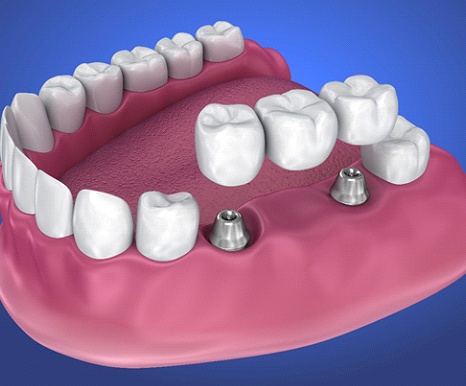 implant multiple tooth fixed dental retained implants bridges spring missing teeth bridge partial dentures benefits because tx