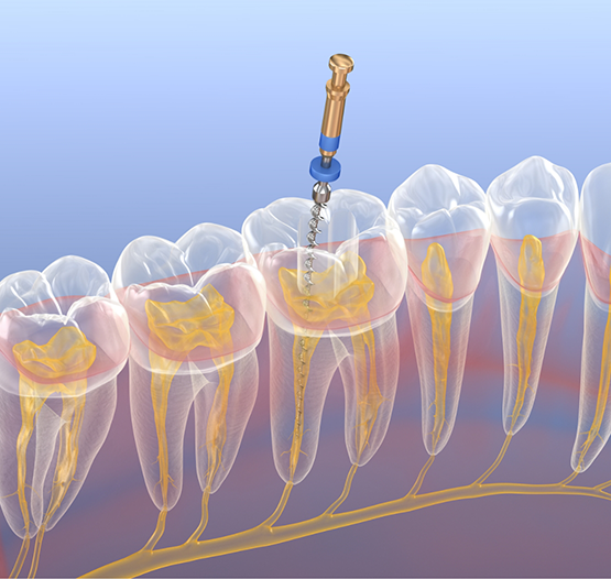 Thin dental instrument performing root canal treatment on a tooth