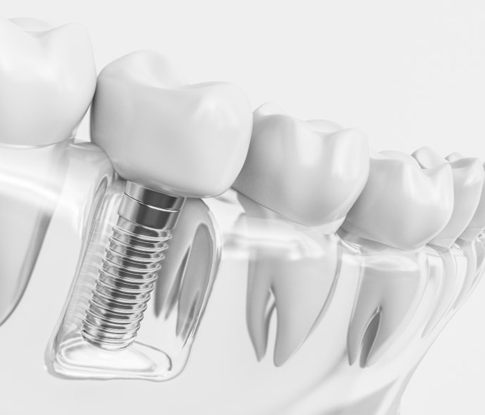 a 3D illustration of a dental implant