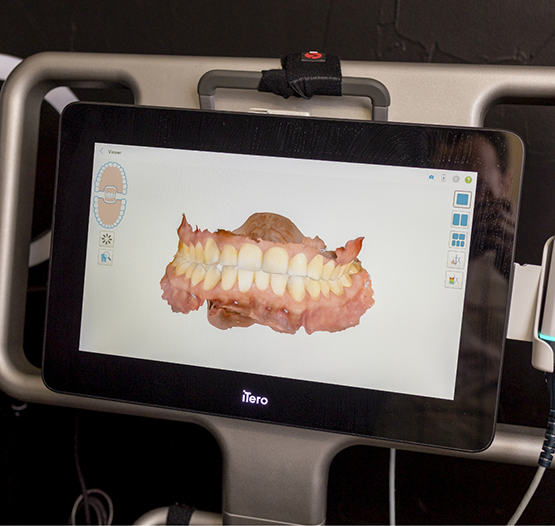 Monitor showing digital scans of a patient's teeth