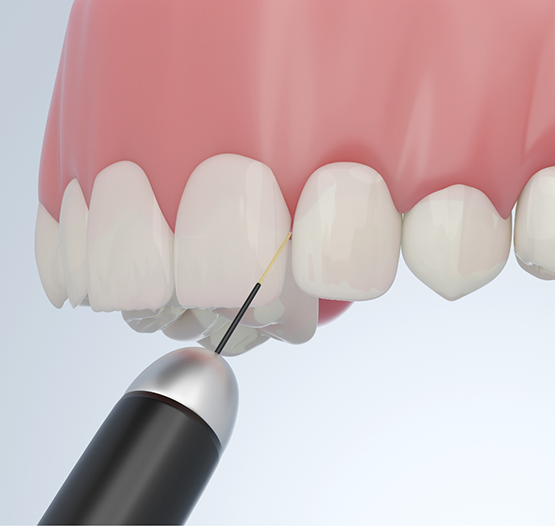 Illustration of a dental laser treating the gums