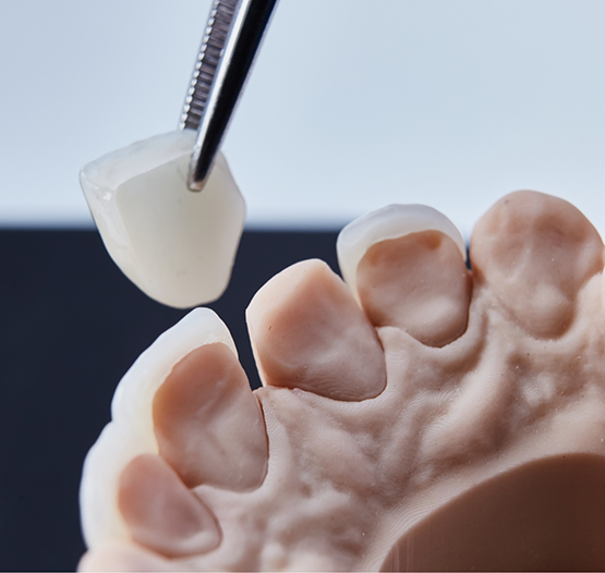 Tweezers placing a veneer over a model of a tooth