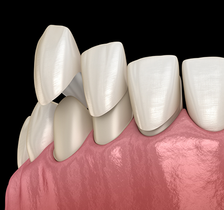 Illustration of veneers being placed over the fronts of teeth