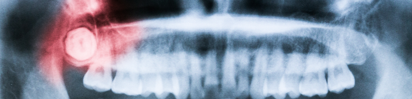 X ray of teeth with an impacted wisdom tooth highlighted red