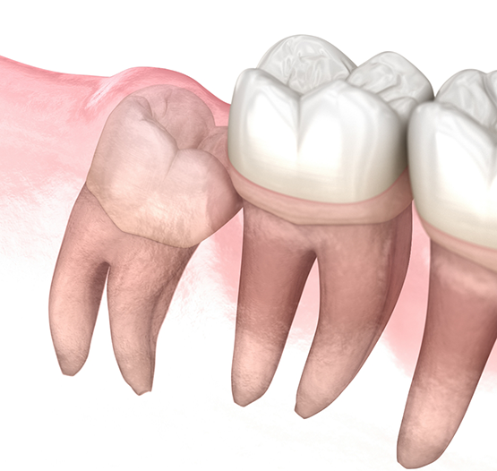 Illustration of an impacted wisdom tooth pressing against the adjacent tooth