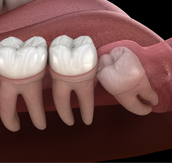 Illustrated wisdom tooth pressing against a tooth next to it
